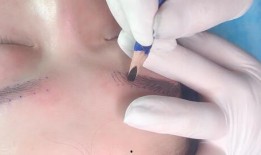 爆料桂哥抽脂视频教程大全,揭秘脂肪管理新潮流